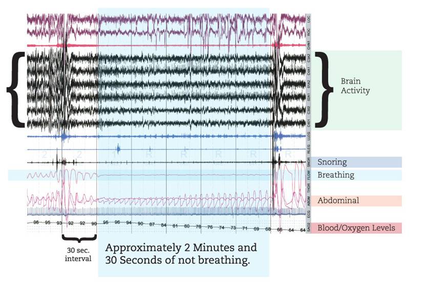 Skaggzzz Sleep Institute Sleep Study Results Example